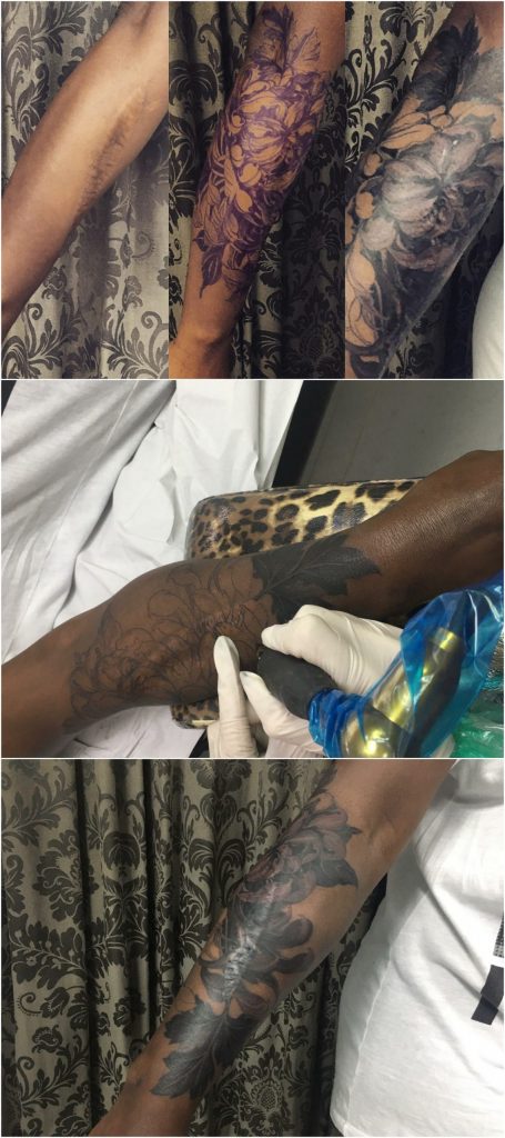 tattoo cicatrices, Cicatriz, tatuaje oncologico, Tatuaje médico-estético, operación cicatriz, micropigmentación, tattoo madrid, tratamiento cicatrices madrid, pigmentación Paramédica, pigmentación, camuflaje cicatrices, estrías, queloide, quemaduras, operación, disimular cicatriz